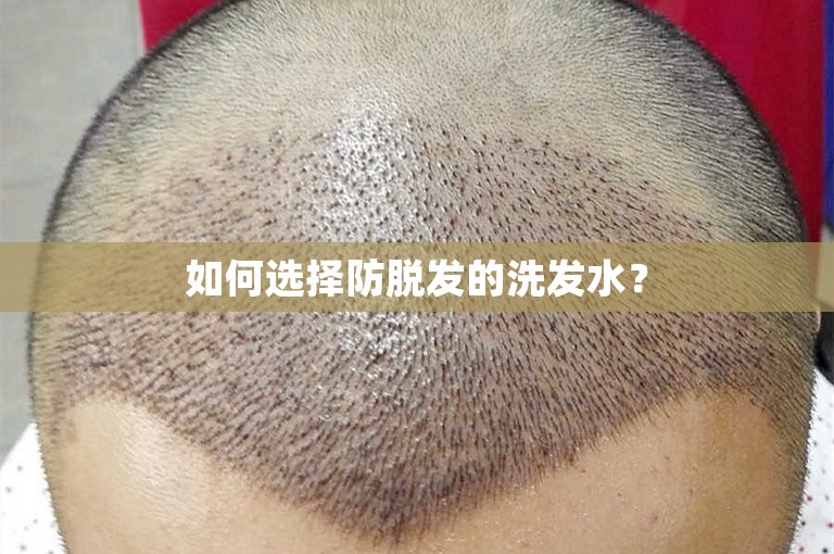 如何选择防脱发的洗发水？