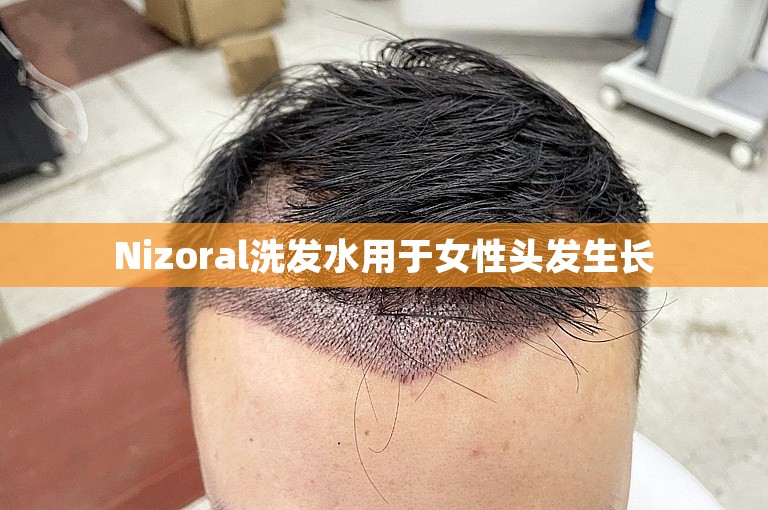 Nizoral洗发水用于女性头发生长