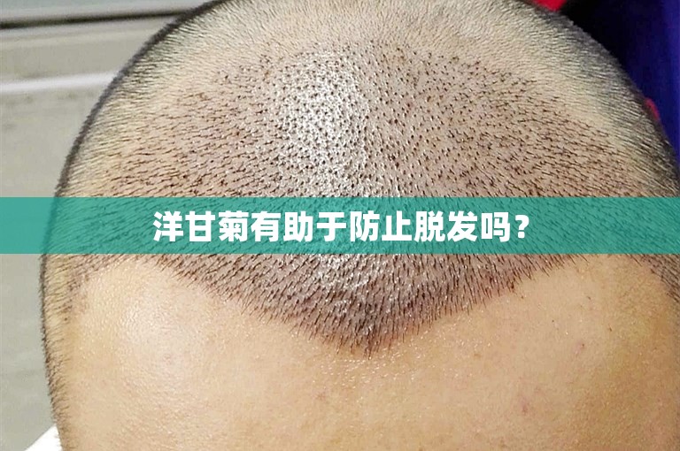 洋甘菊有助于防止脱发吗？