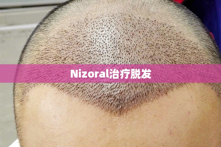 Nizoral治疗脱发