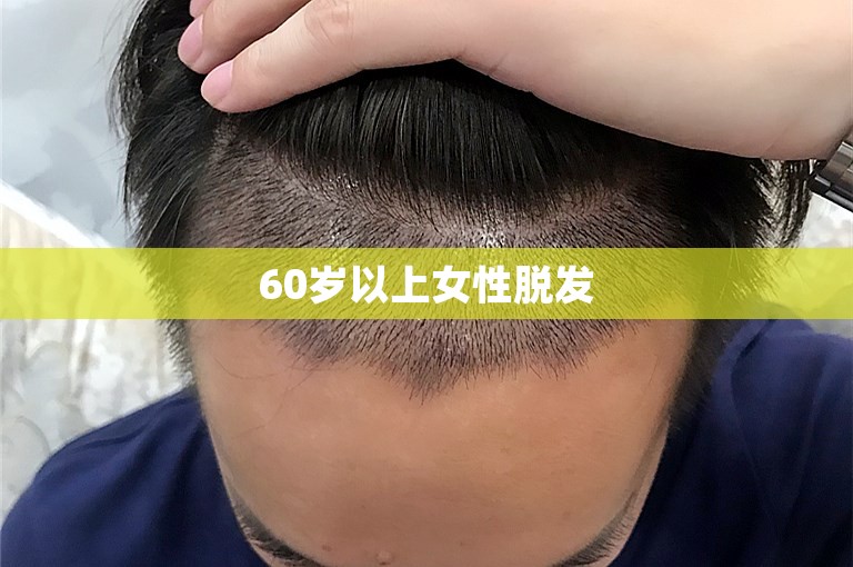 60岁以上女性脱发