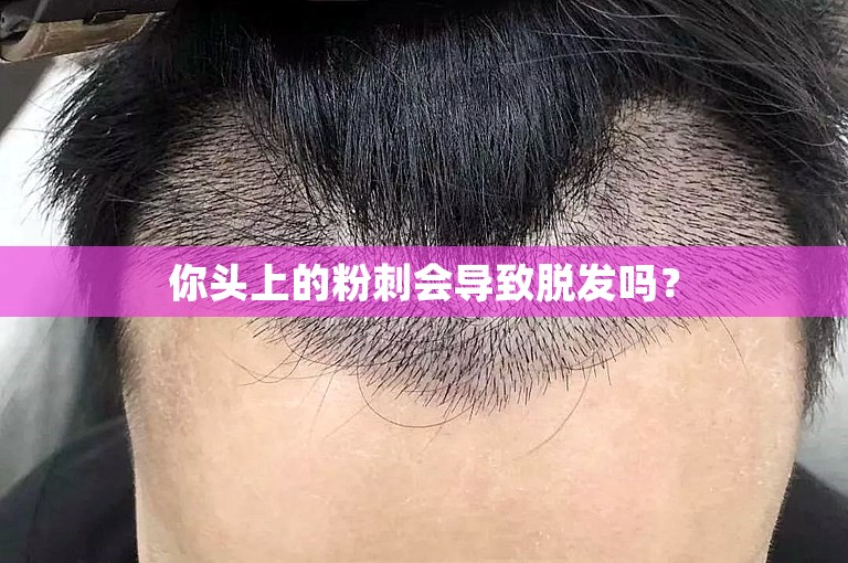 你头上的粉刺会导致脱发吗？