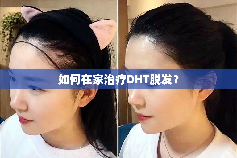 如何在家治疗DHT脱发？