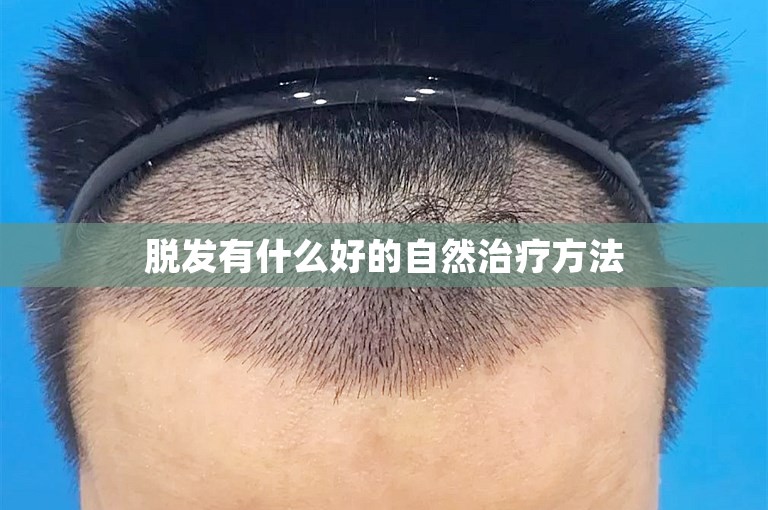 脱发有什么好的自然治疗方法