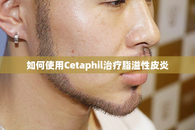 如何使用Cetaphil治疗脂溢性皮炎