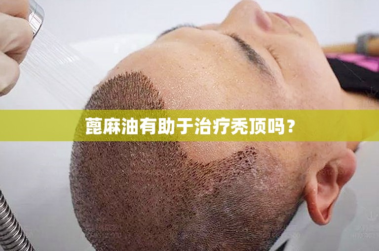 蓖麻油有助于治疗秃顶吗？