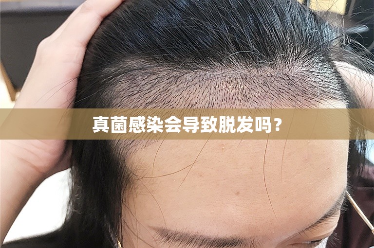 真菌感染会导致脱发吗？