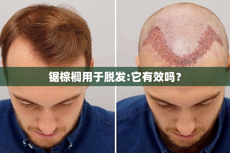锯棕榈用于脱发:它有效吗？