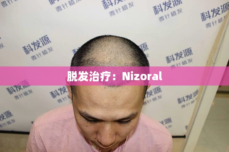 脱发治疗：Nizoral