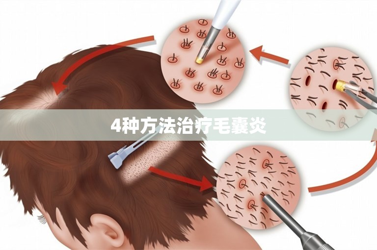 4种方法治疗毛囊炎