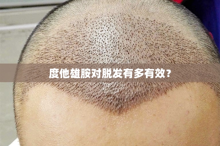 度他雄胺对脱发有多有效？