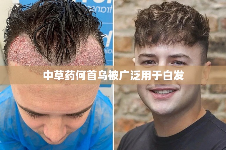 中草药何首乌被广泛用于白发