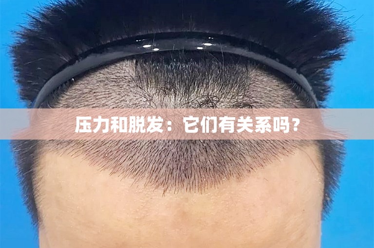 压力和脱发：它们有关系吗？