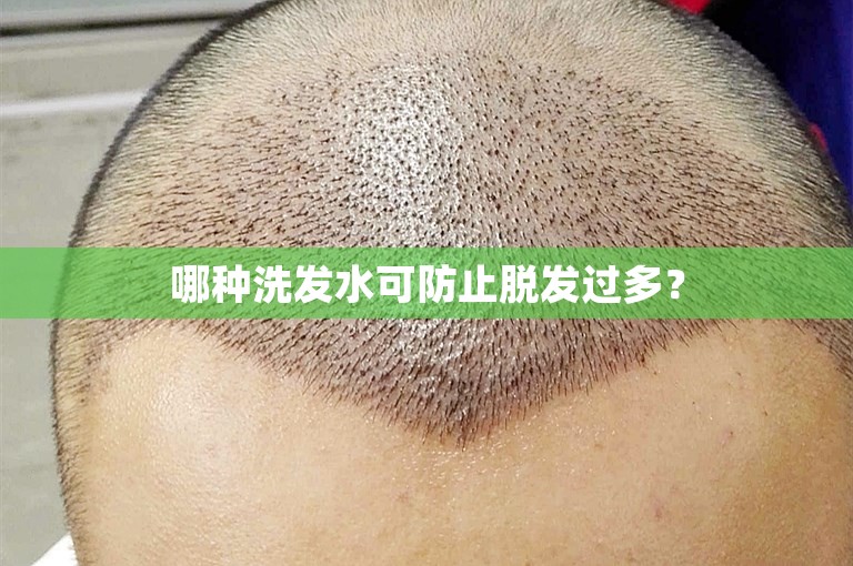 哪种洗发水可防止脱发过多？