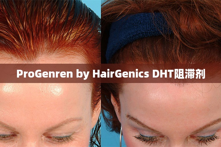 ProGenren by HairGenics DHT阻滞剂