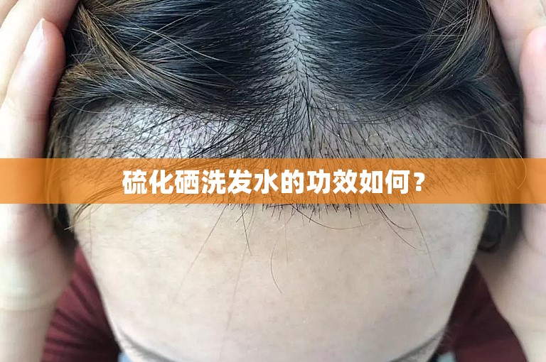 硫化硒洗发水的功效如何？