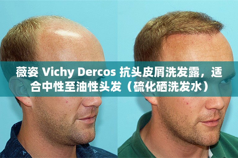 薇姿 Vichy Dercos 抗头皮屑洗发露，适合中性至油性头发（硫化硒洗发水）