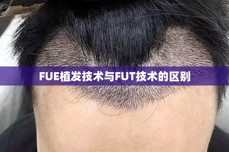 FUE植发技术与FUT技术的区别