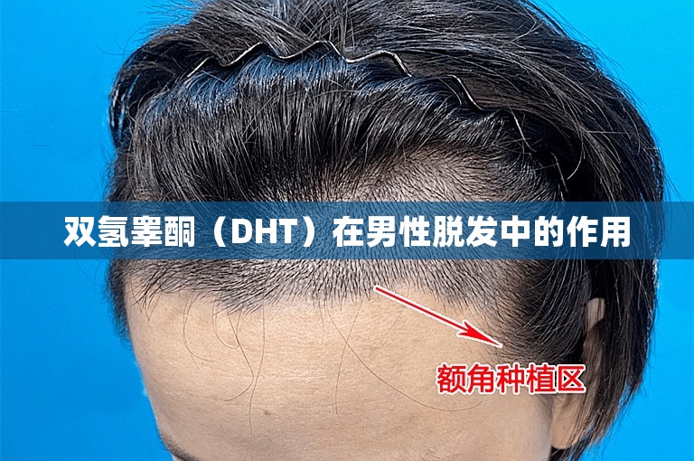 双氢睾酮（DHT）在男性脱发中的作用