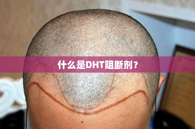 什么是DHT阻断剂？