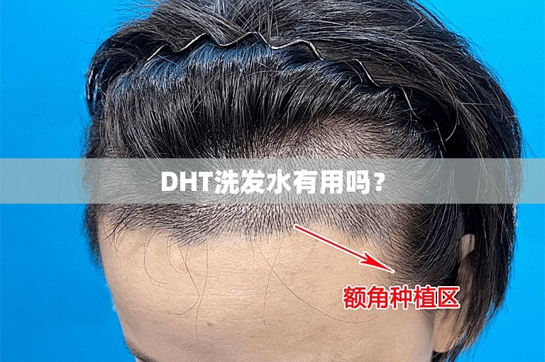 DHT洗发水有用吗？