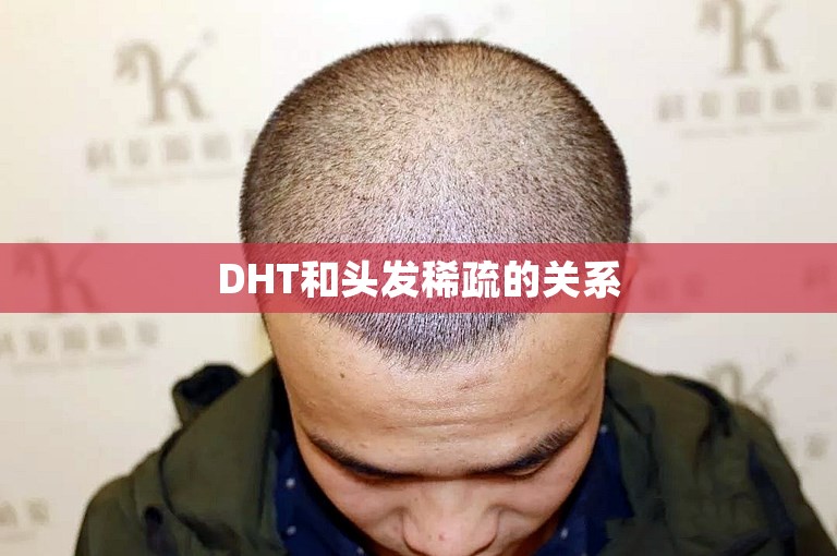 DHT和头发稀疏的关系