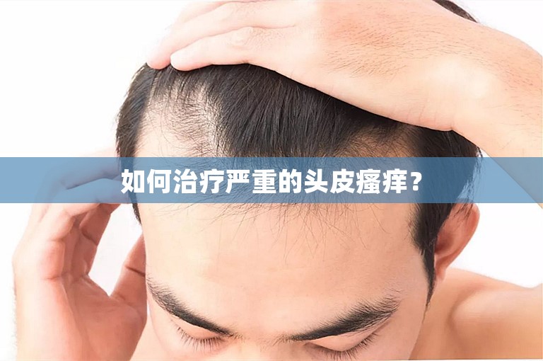 如何治疗严重的头皮瘙痒？