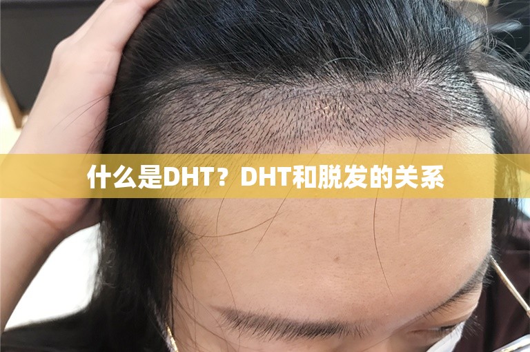 什么是DHT？DHT和脱发的关系