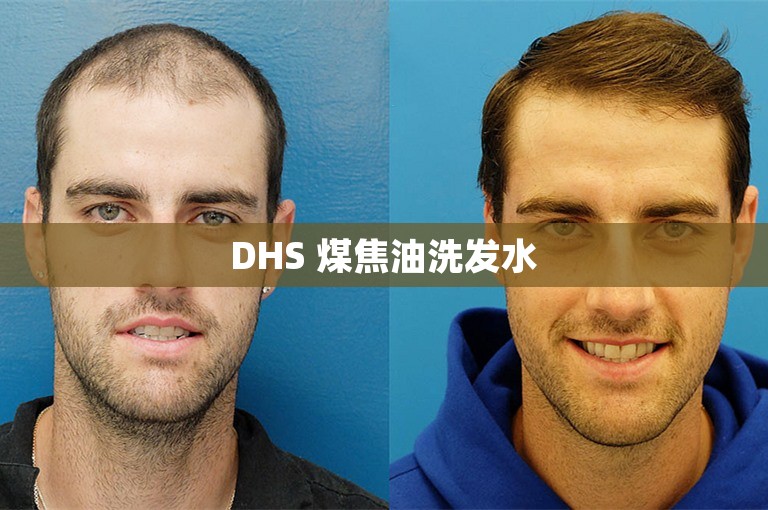 DHS 煤焦油洗发水