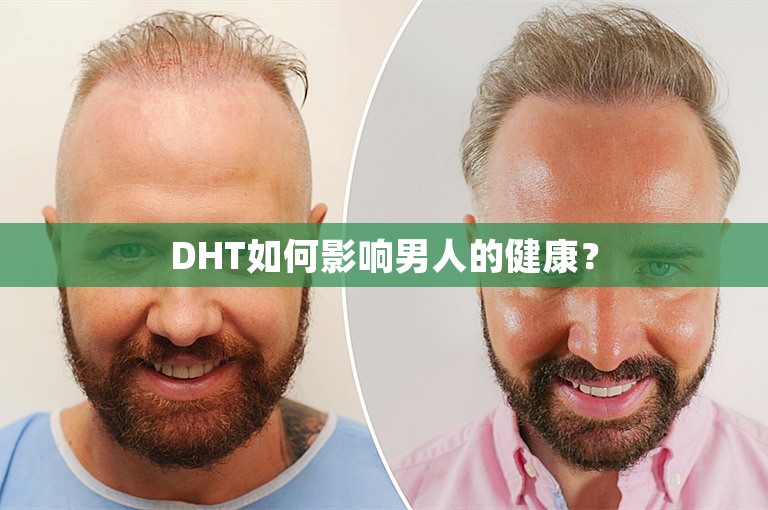 DHT如何影响男人的健康？