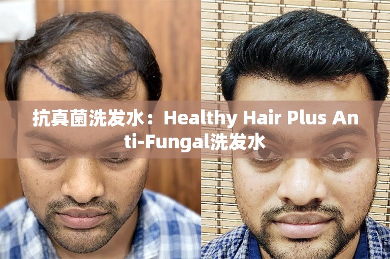 抗真菌洗发水：Healthy Hair Plus Anti-Fungal洗发水