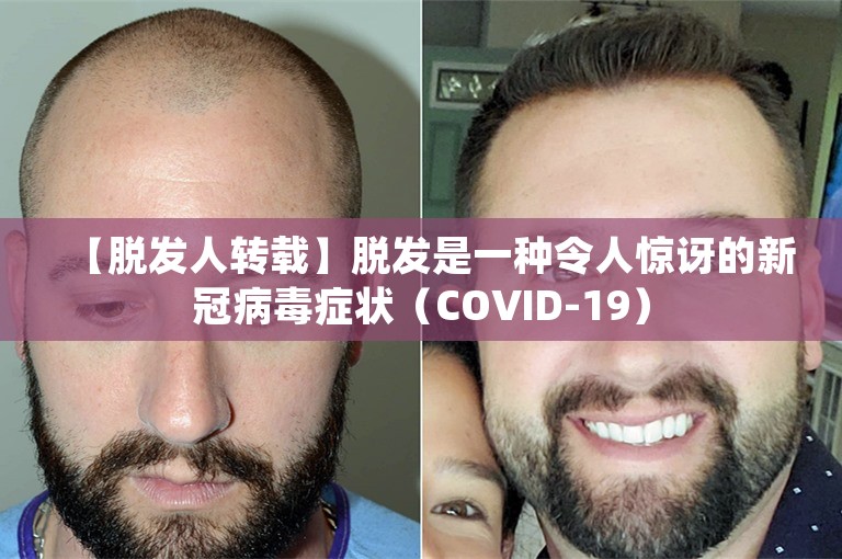【脱发人转载】脱发是一种令人惊讶的新冠病毒症状（COVID-19）
