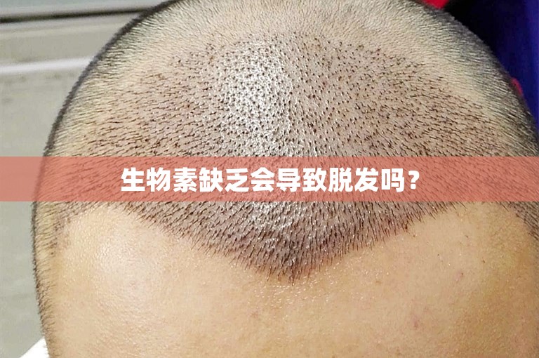 生物素缺乏会导致脱发吗？