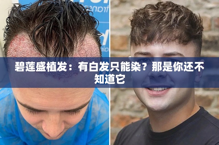 碧莲盛植发：有白发只能染？那是你还不知道它