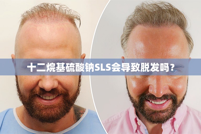 十二烷基硫酸钠SLS会导致脱发吗？