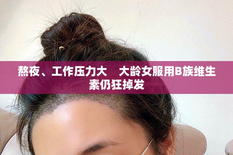 熬夜、工作压力大　大龄女服用B族维生素仍狂掉发