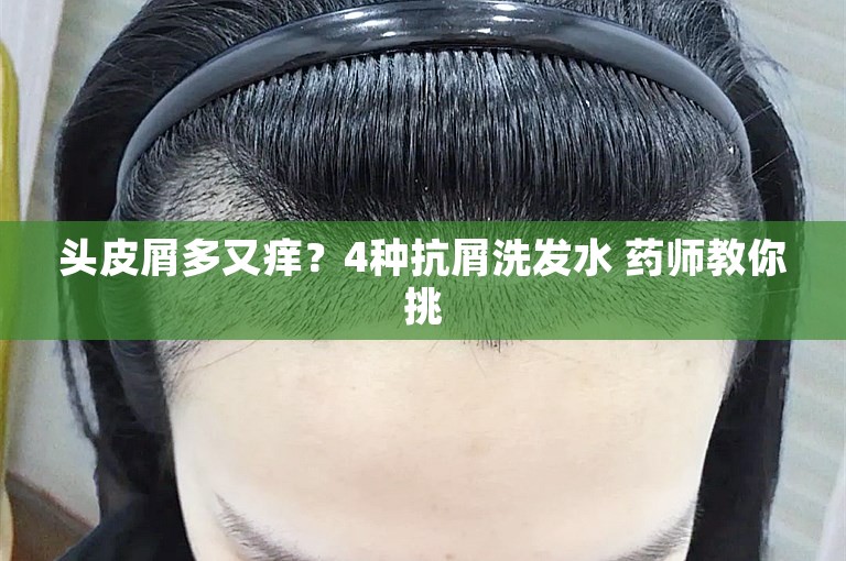 头皮屑多又痒？4种抗屑洗发水 药师教你挑