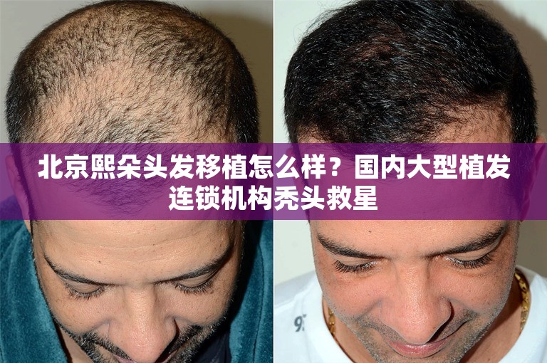 北京熙朵头发移植怎么样？国内大型植发连锁机构秃头救星
