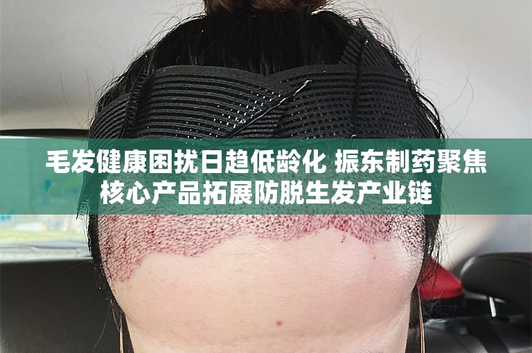 毛发健康困扰日趋低龄化 振东制药聚焦核心产品拓展防脱生发产业链