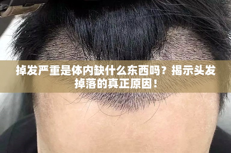 掉发严重是体内缺什么东西吗？揭示头发掉落的真正原因！