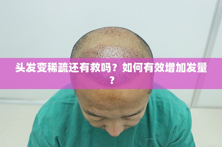 头发变稀疏还有救吗？如何有效增加发量？