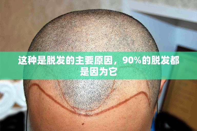 这种是脱发的主要原因，90%的脱发都是因为它