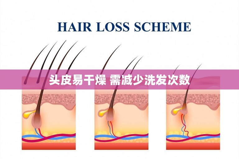 头皮易干燥 需减少洗发次数