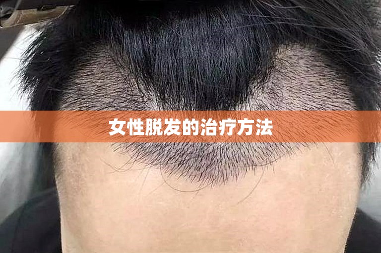 女性脱发的治疗方法