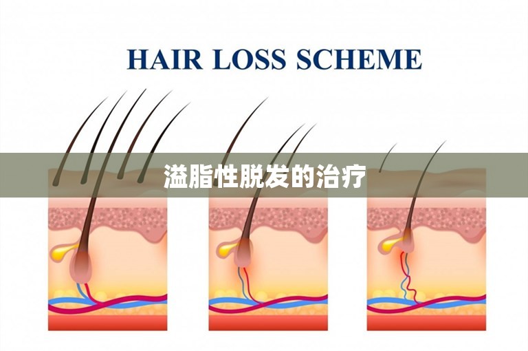 溢脂性脱发的治疗