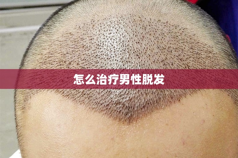 怎么治疗男性脱发