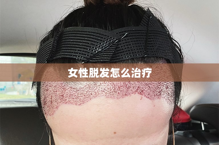 女性脱发怎么治疗