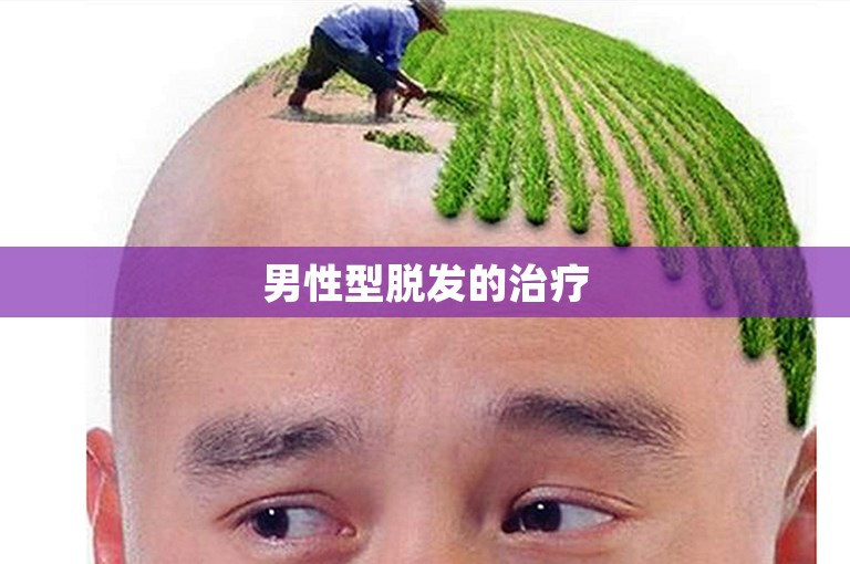 男性型脱发的治疗