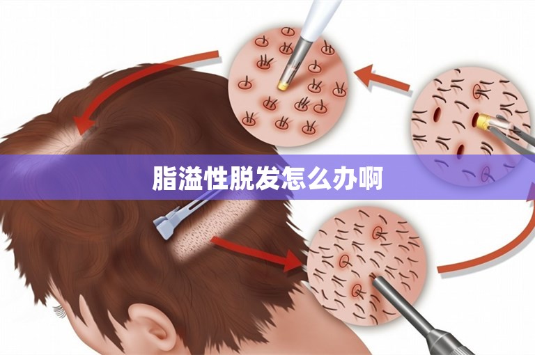 脂溢性脱发怎么办啊