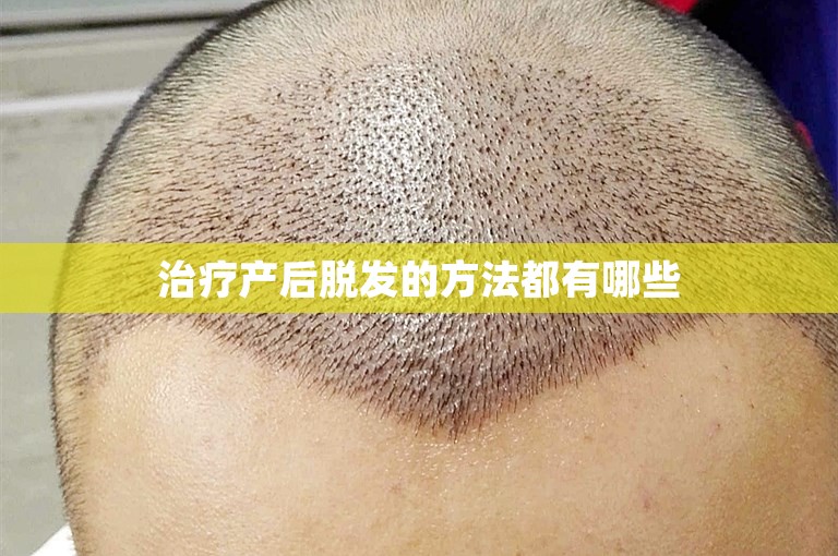 治疗产后脱发的方法都有哪些